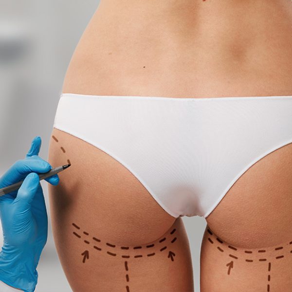 FILLER-GLUTEI-OK